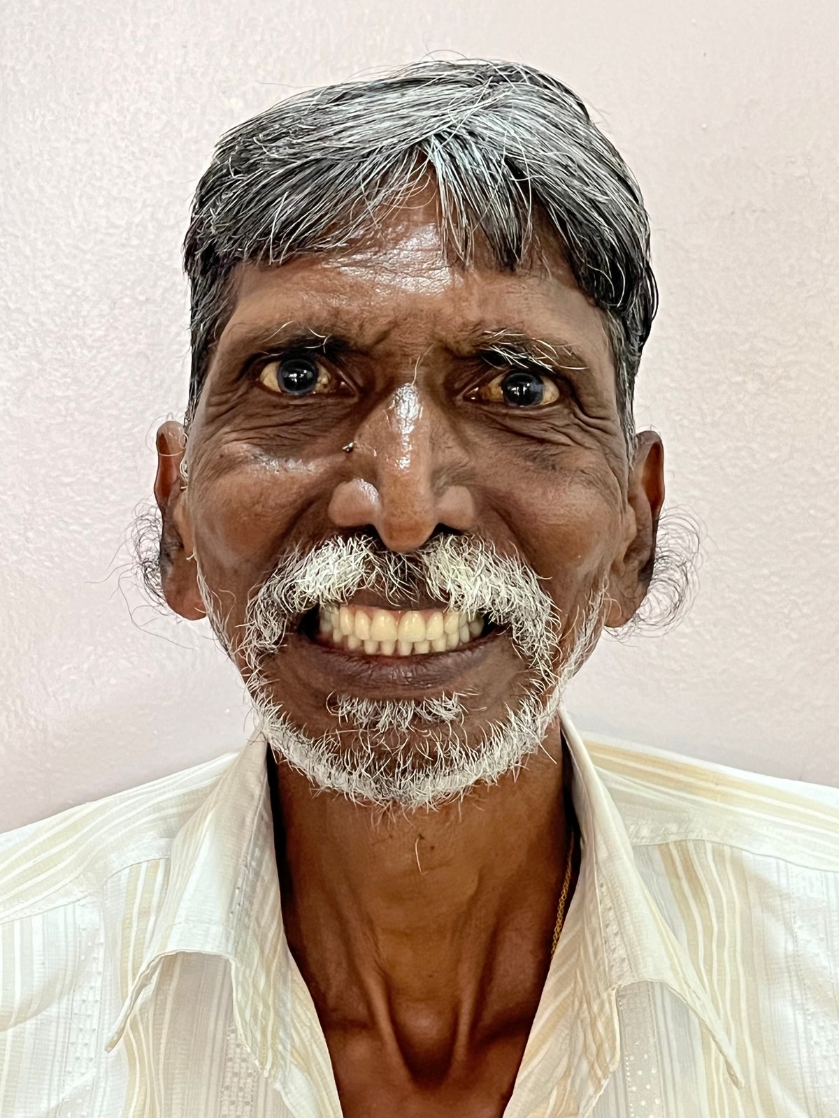 After - Complete smile transformation