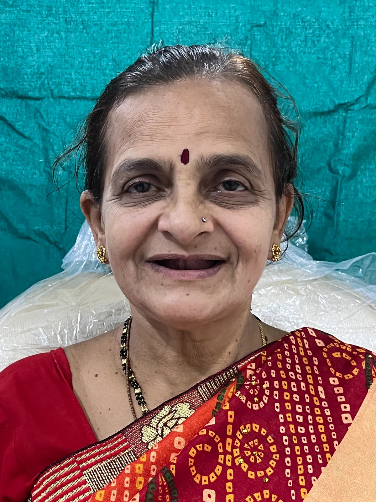 Before - Implant supported complete denture