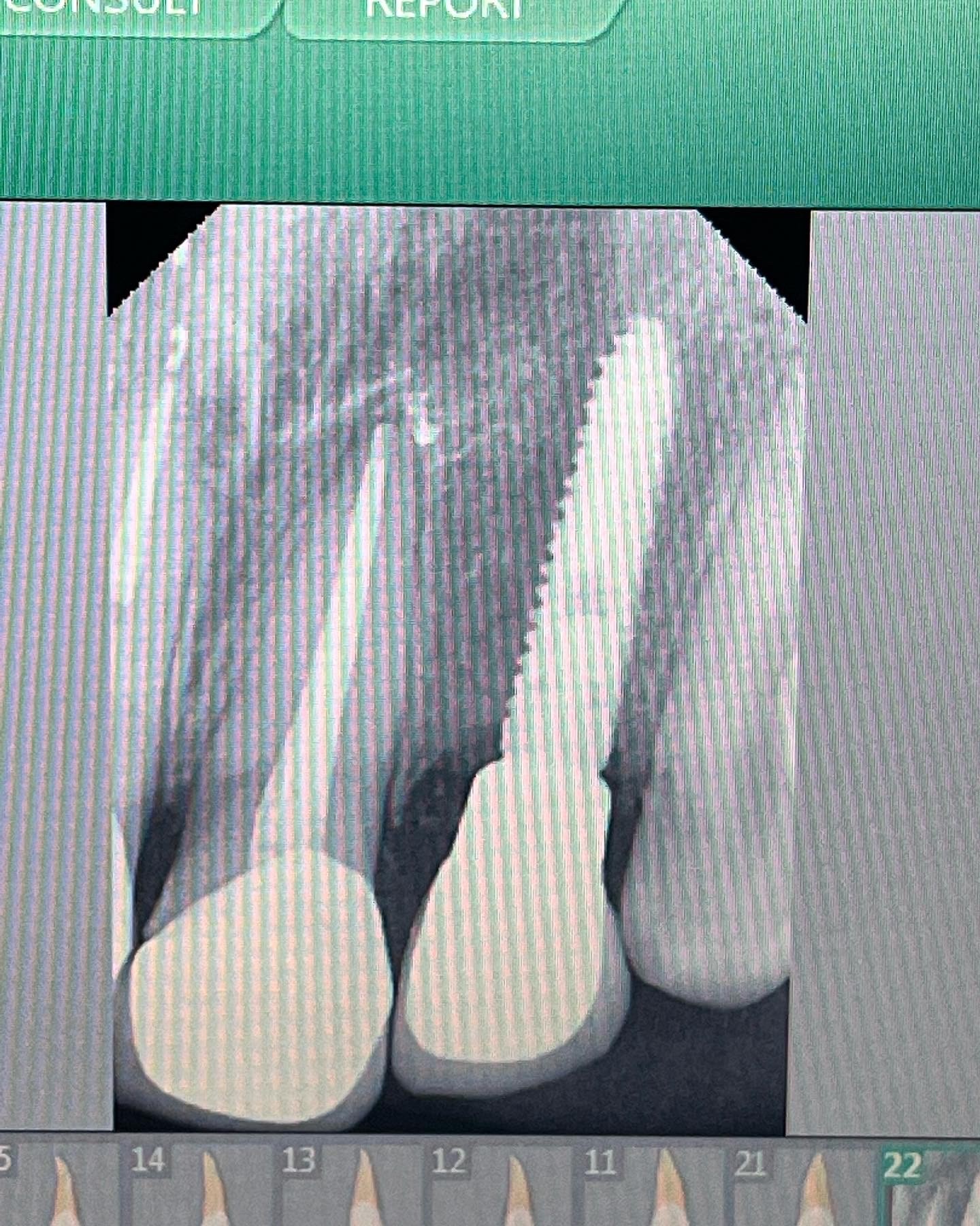 After - Anterior dental implants and smile makeover