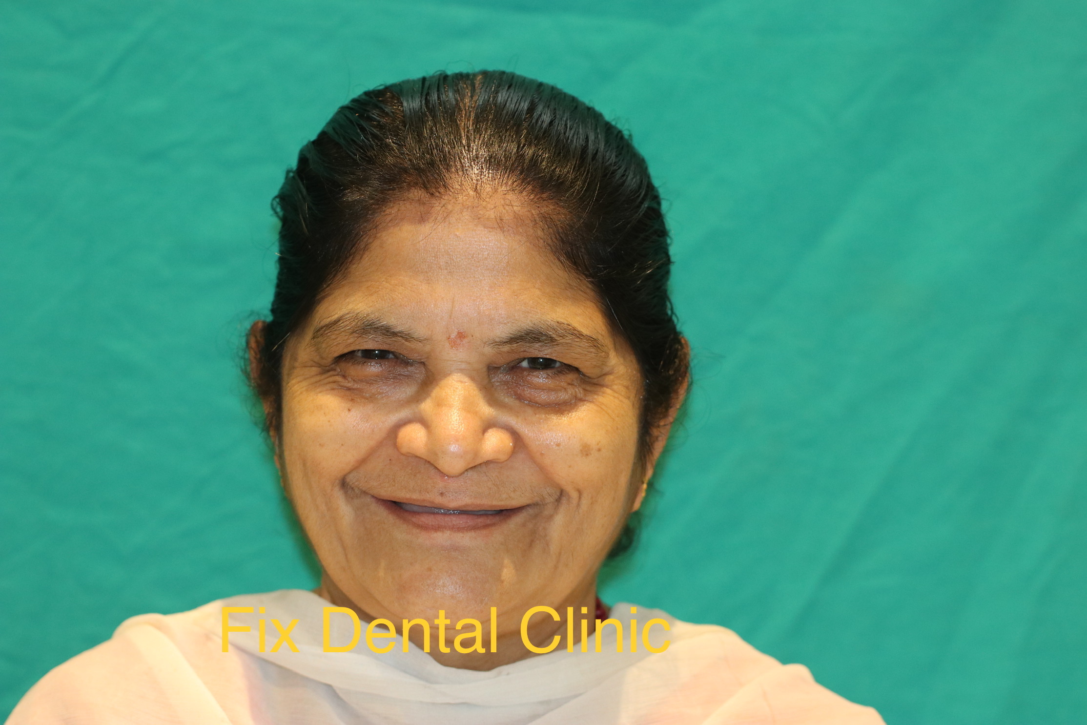 Before - Advanced smile enhancement