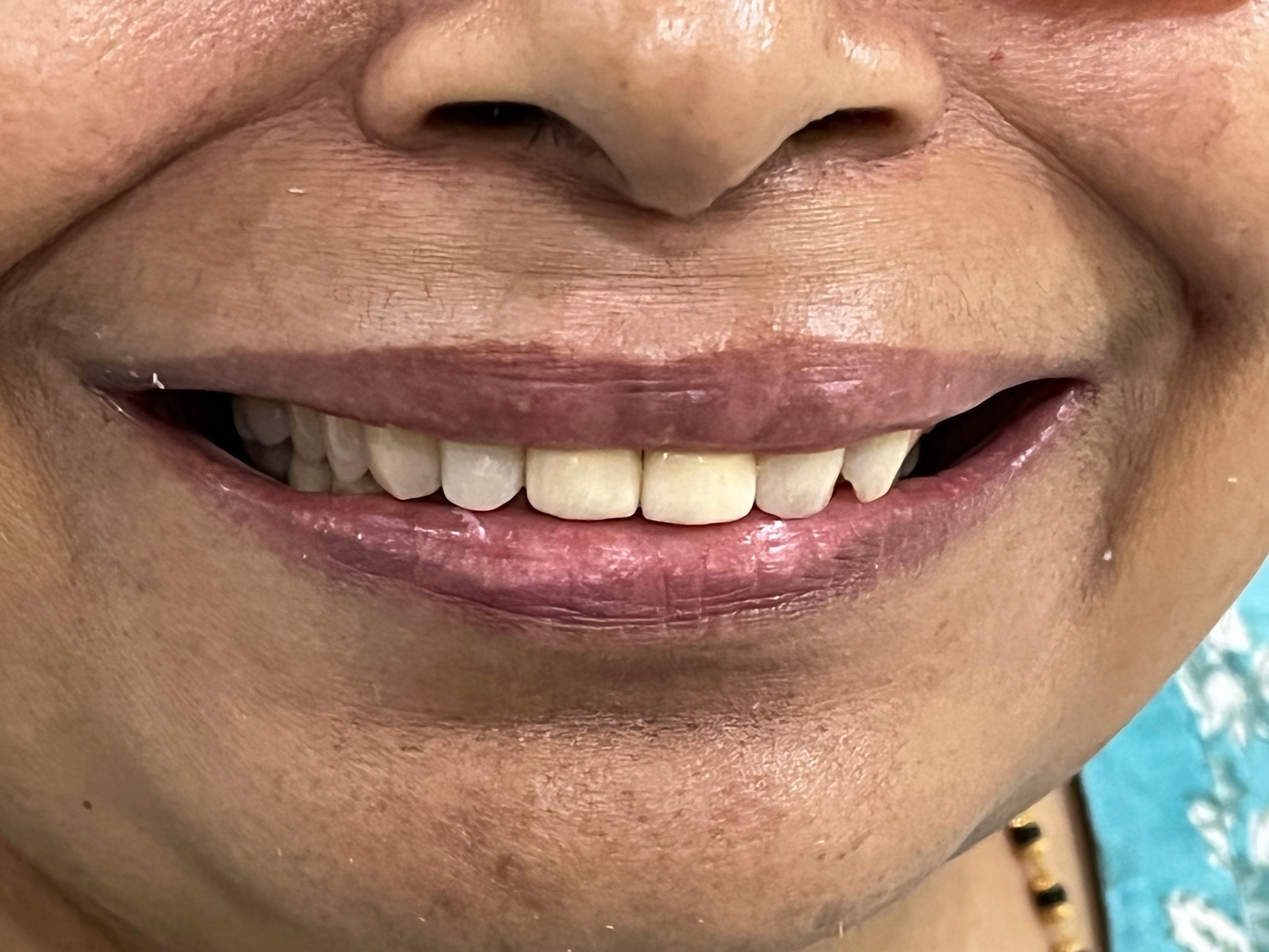 After - Implant-supported restoration