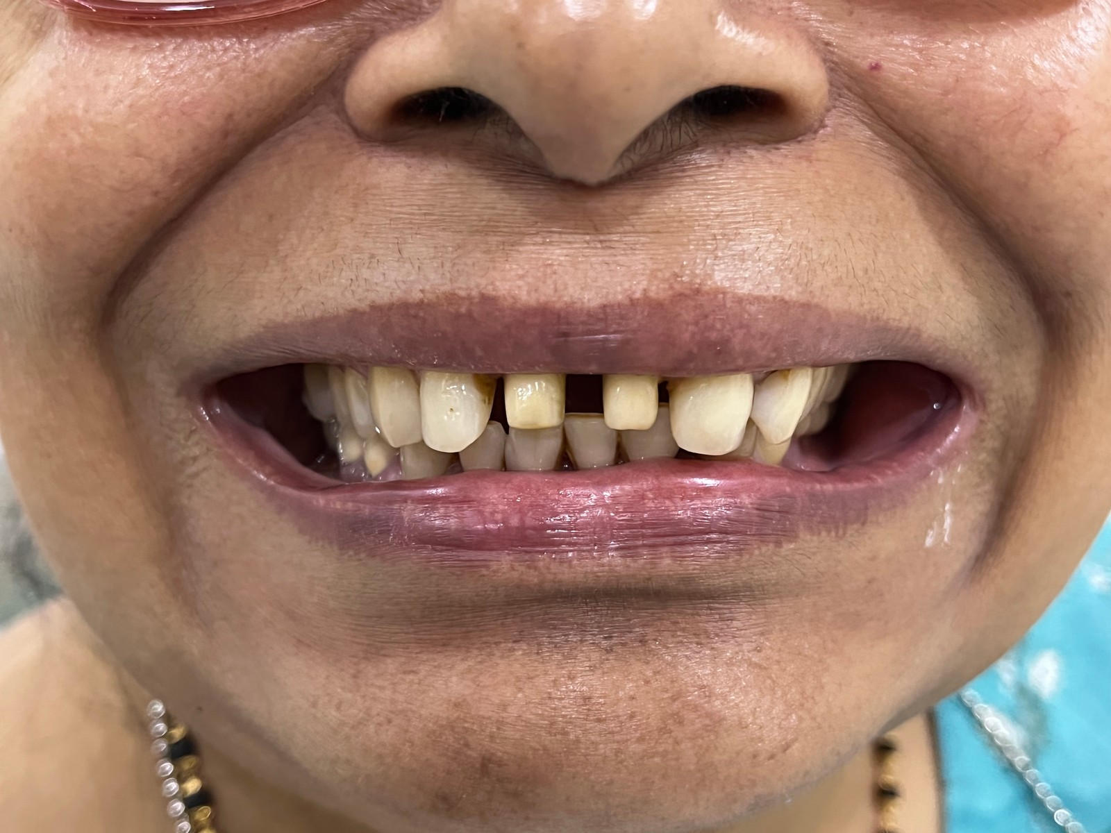 Before - Implant-supported restoration