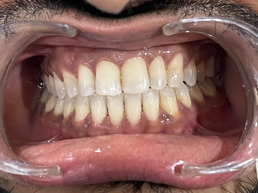 After - Full mouth rehabilitation with full mouth dental implants