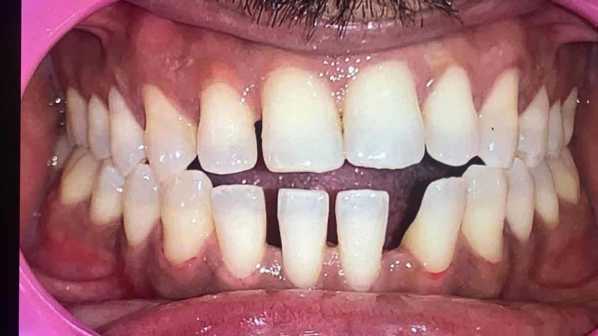 Before - Full mouth rehabilitation with full mouth dental implants