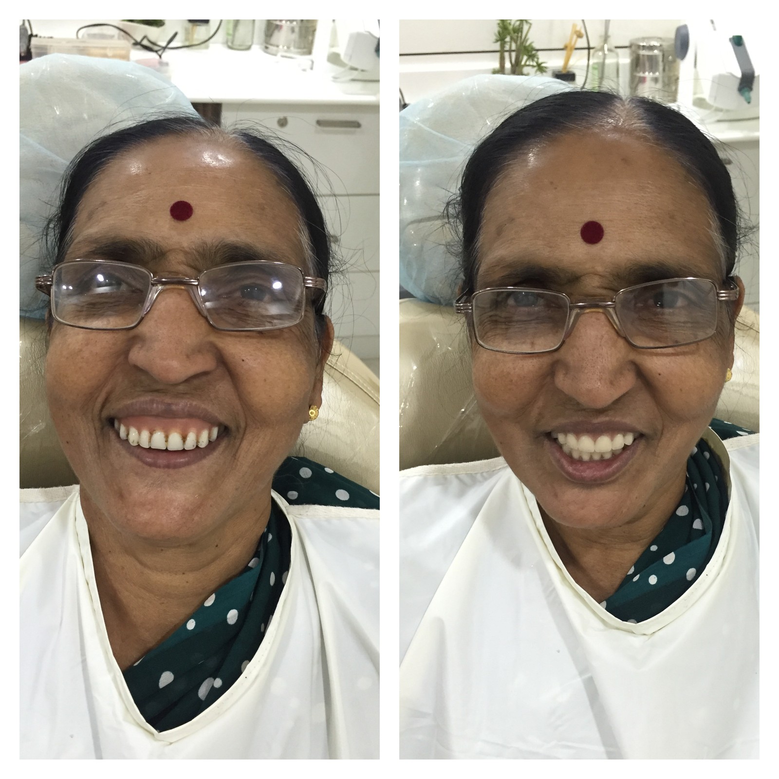 Full Arch Restoration