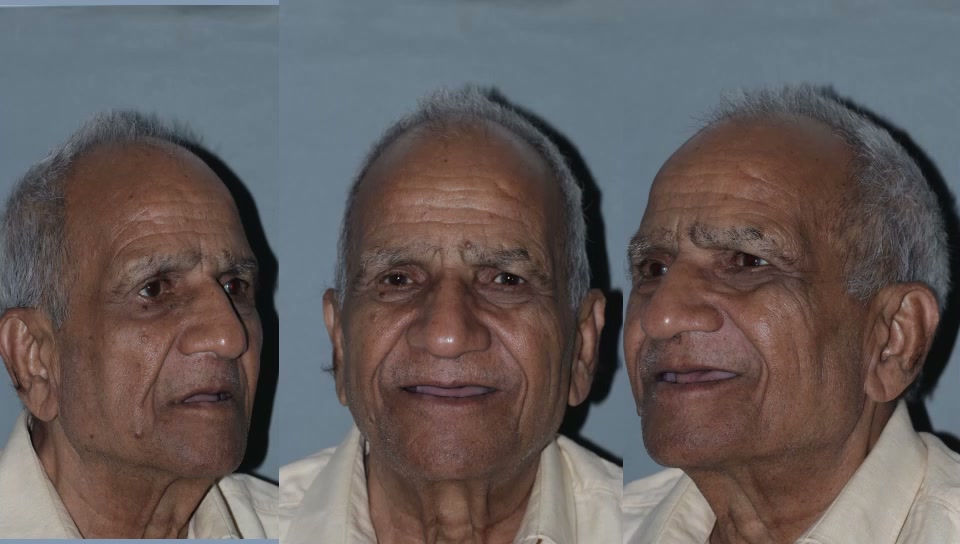 Agarwal Family - Dental Implants